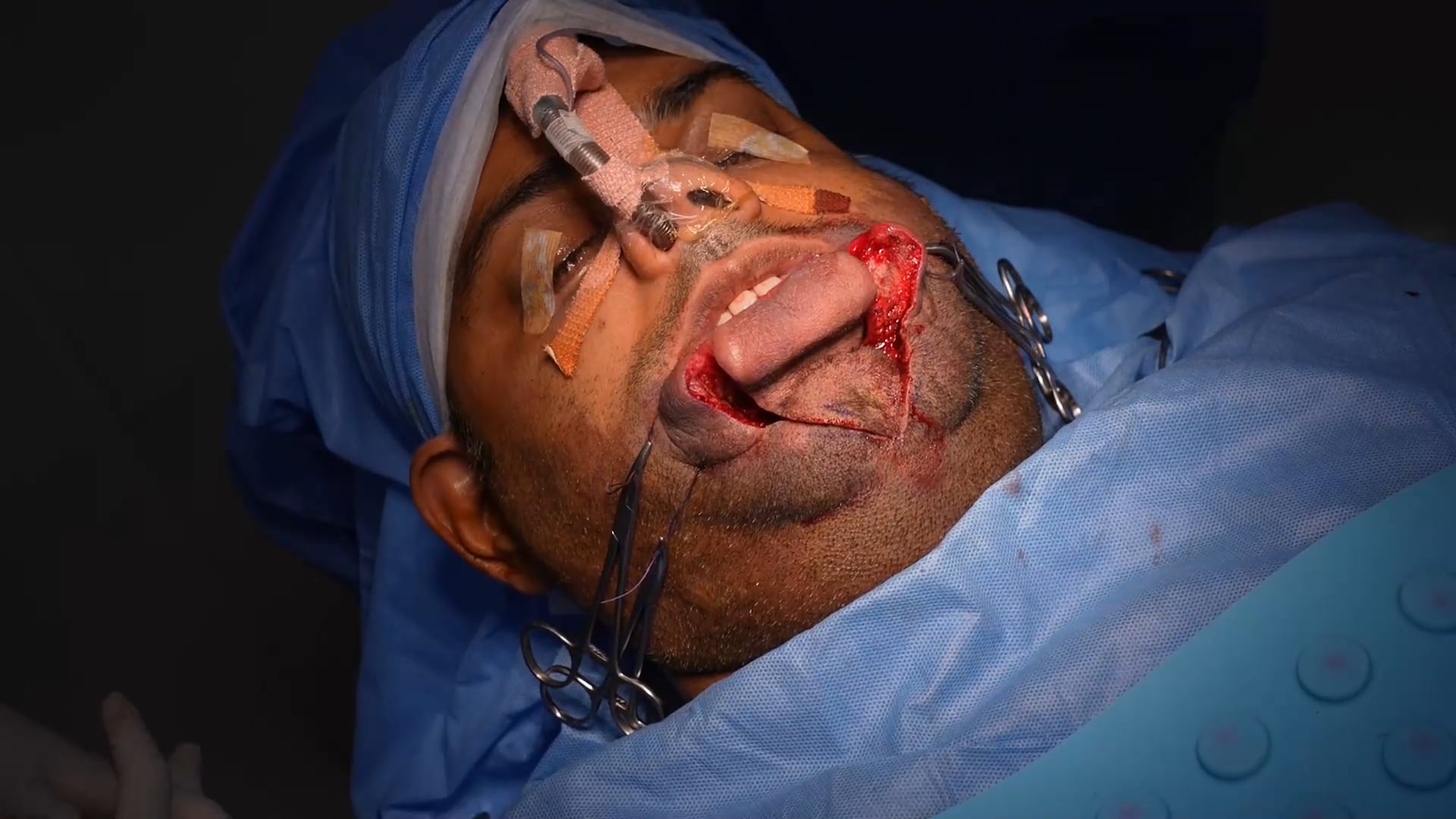 Hemangioma Surgery on lips for a man